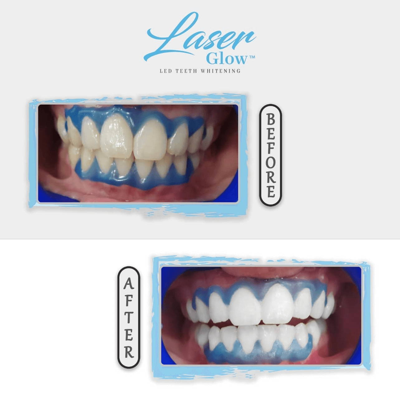 laserglow teeth whitening before and after