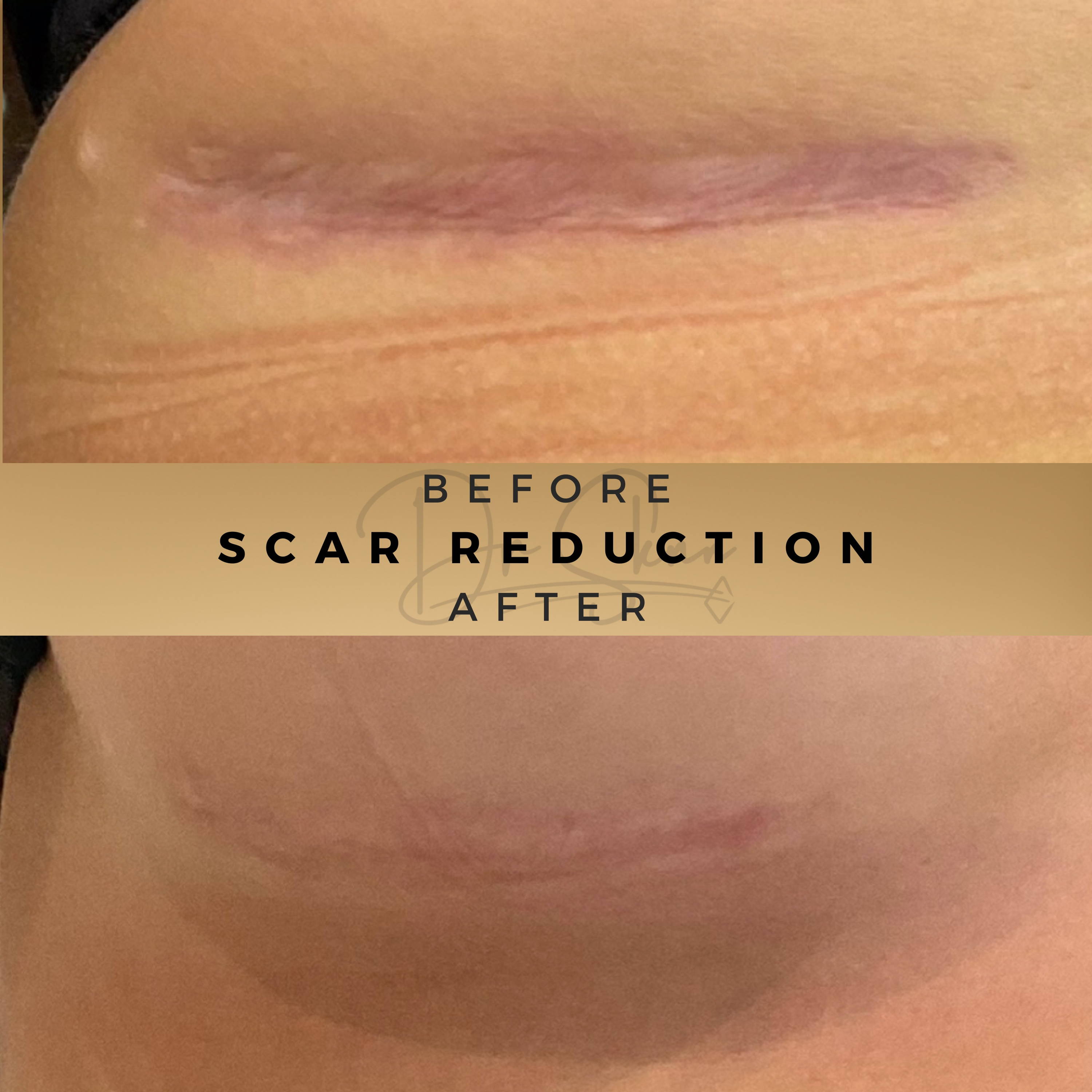 Scar Treatment Wilmslow Before & After Dr Sknn