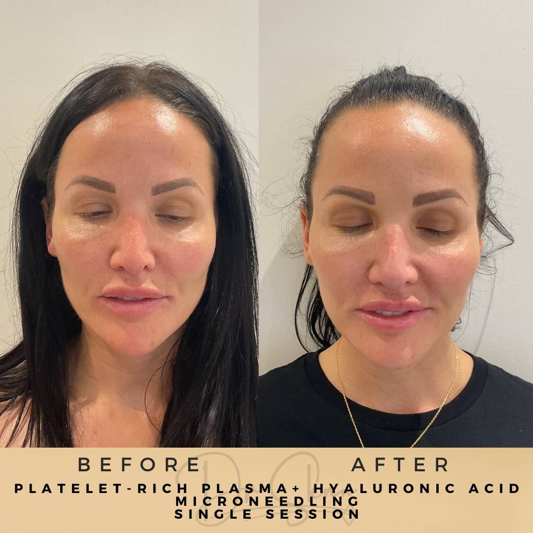 PRP Microneedling - Dr Sknn before and after