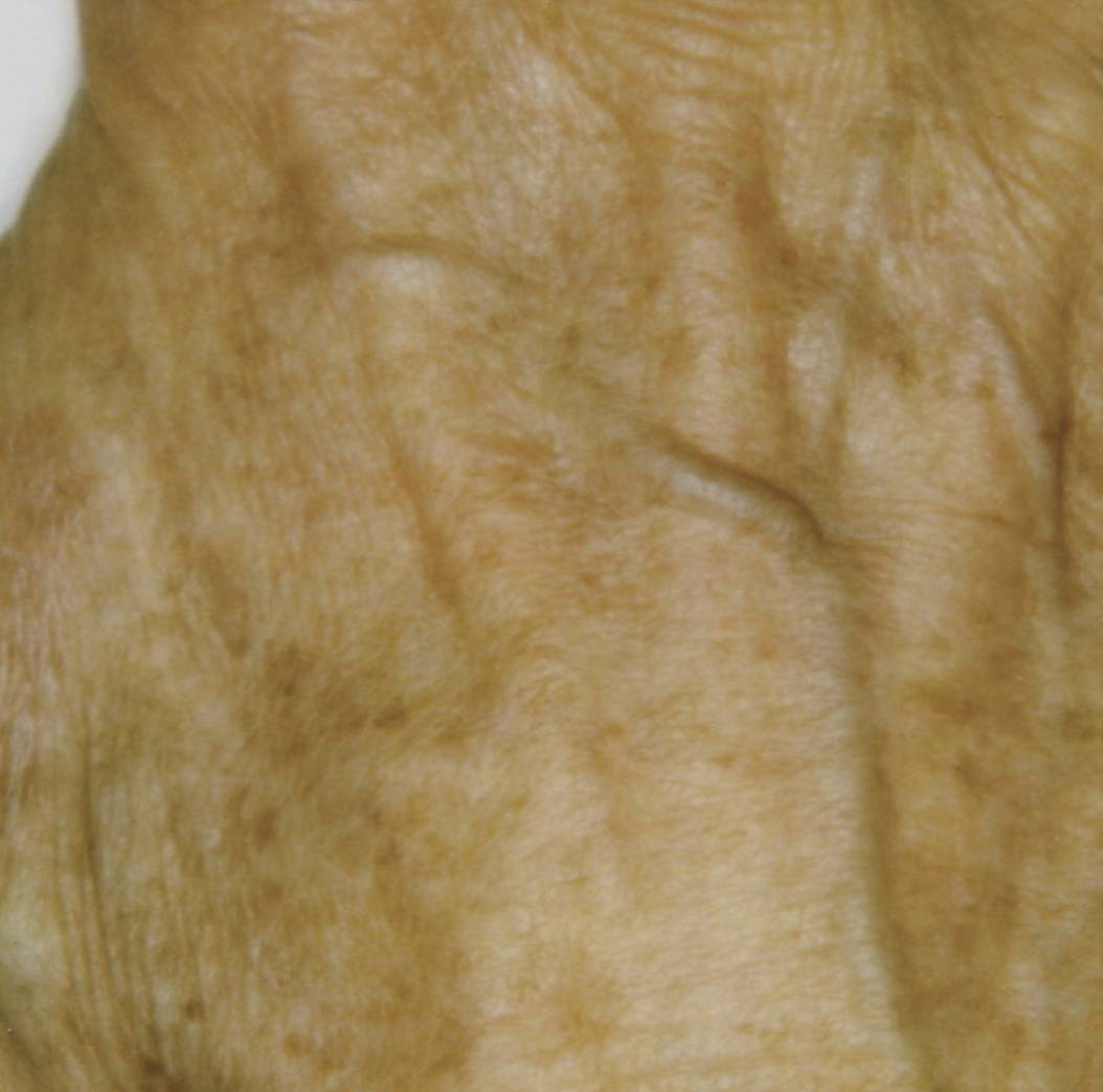 Intense Pulsed Light Pigmentation Removal After