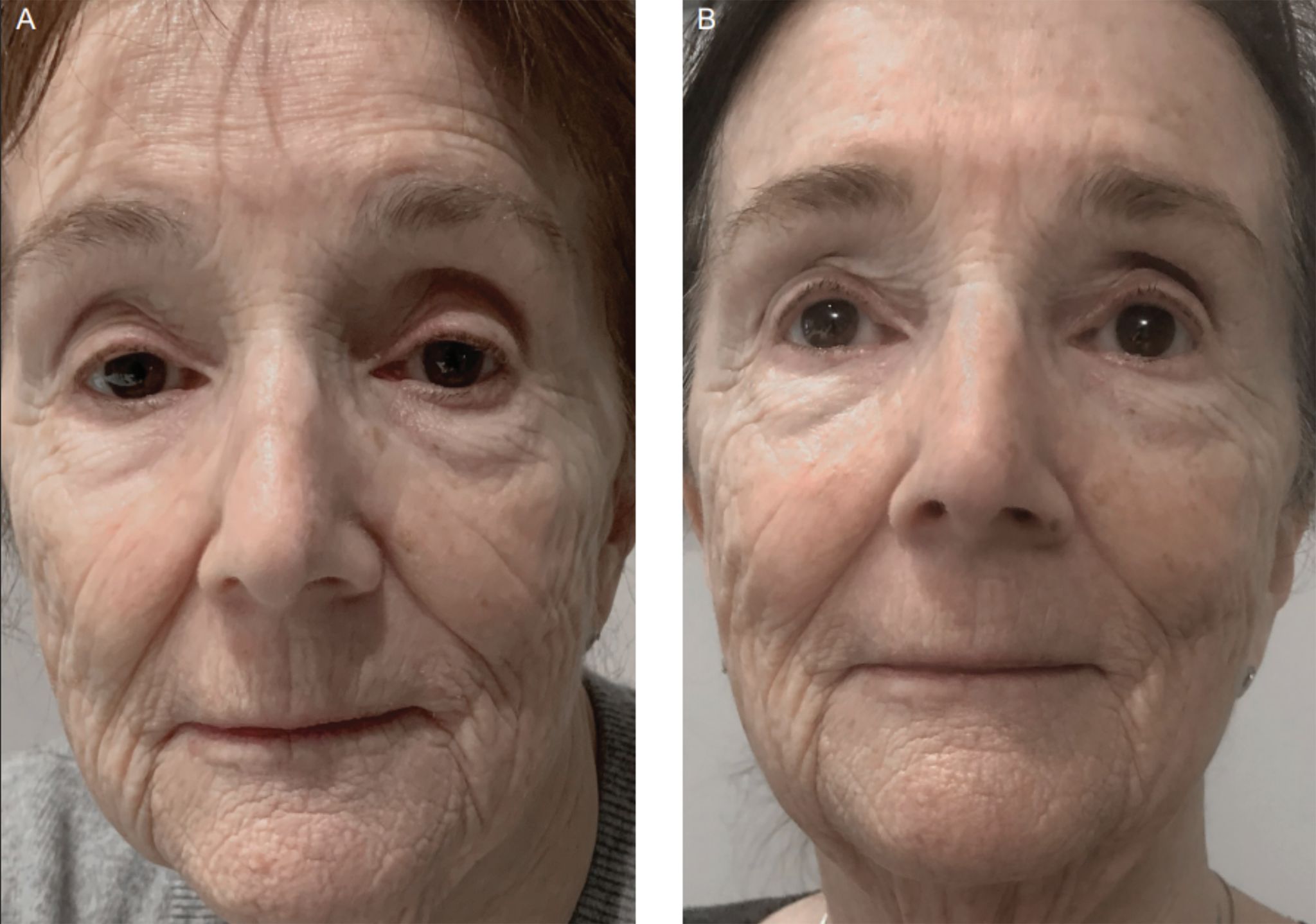 The Best Red Light Therapy Devices—A Clinical Take -