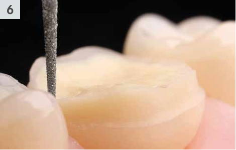 858 diamond bur finishing the interproximal region of a tooth