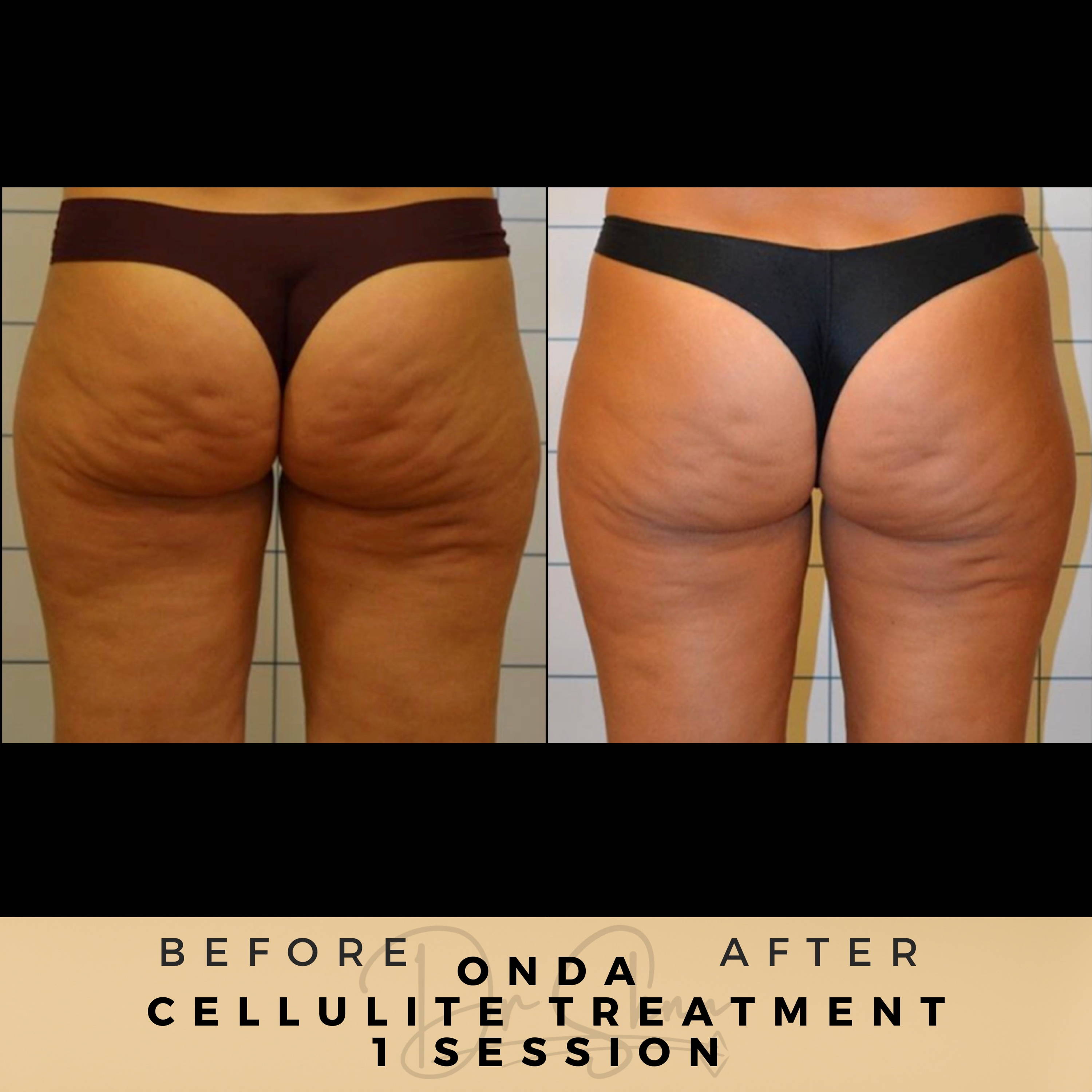 Cellulite Removal - Non-surgical - Dr Sknn before and after