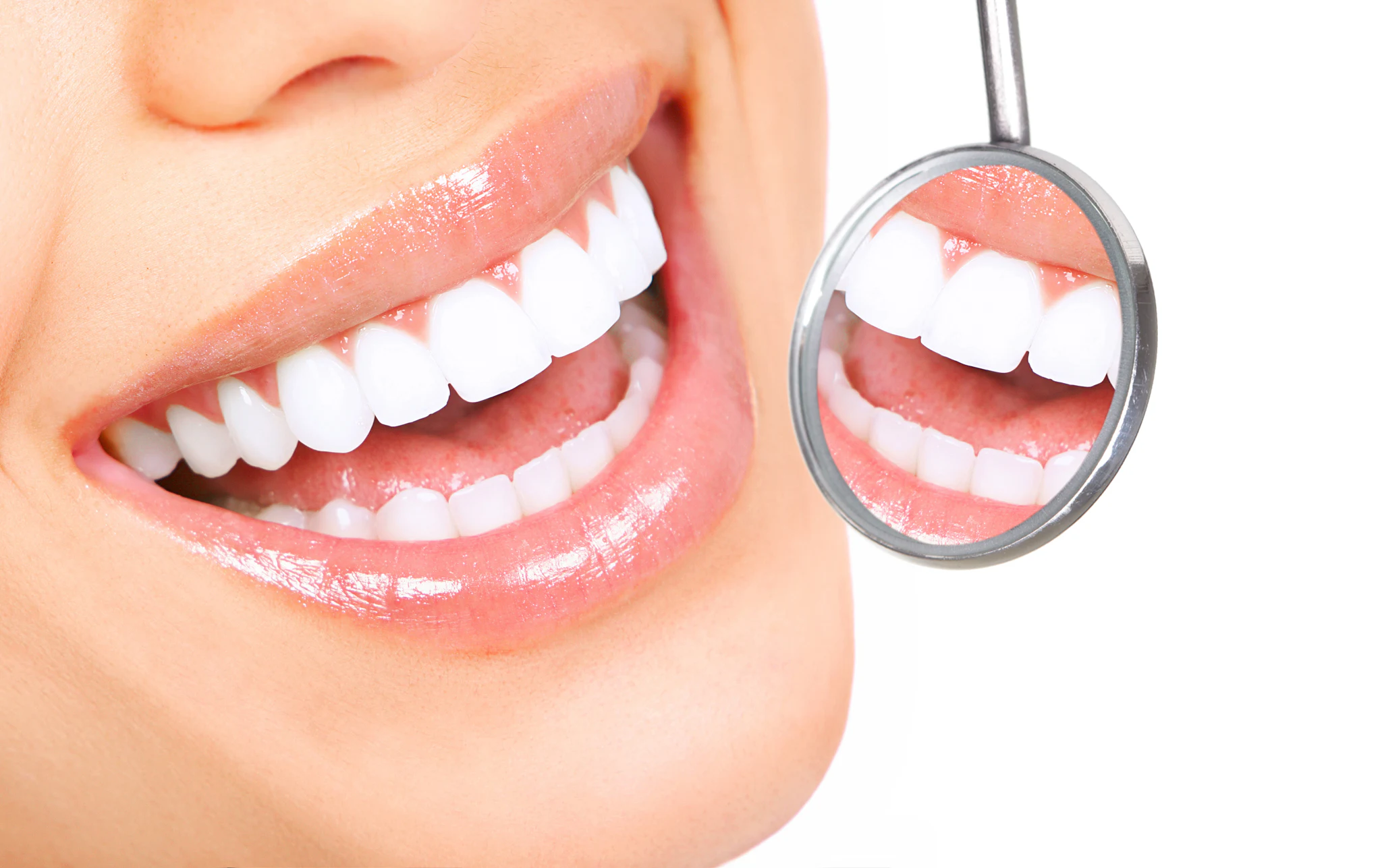 Veneers