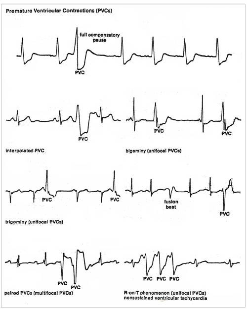 EKG interpretation of Premature Ventricular Contractions (PVC)