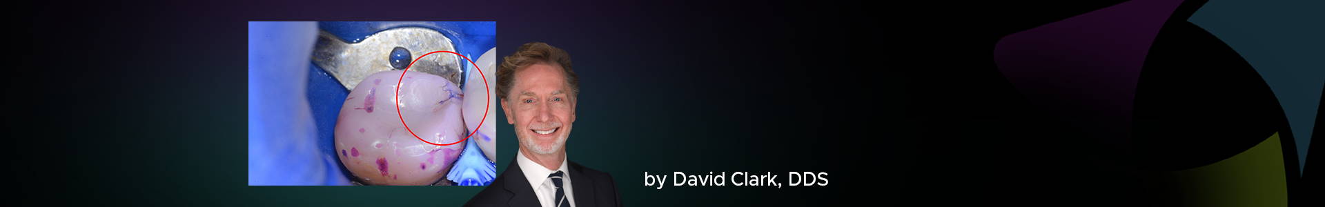 dr. david clark and the image of two adjacent teeth after the application of disclosing solution