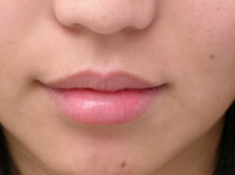 lip injections los angeles