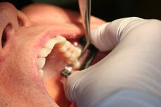 Hand with gloves performing procedure in patient's upper back tooth