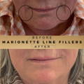 Marionette Line Filler Wilmslow Before & After Dr Sknn