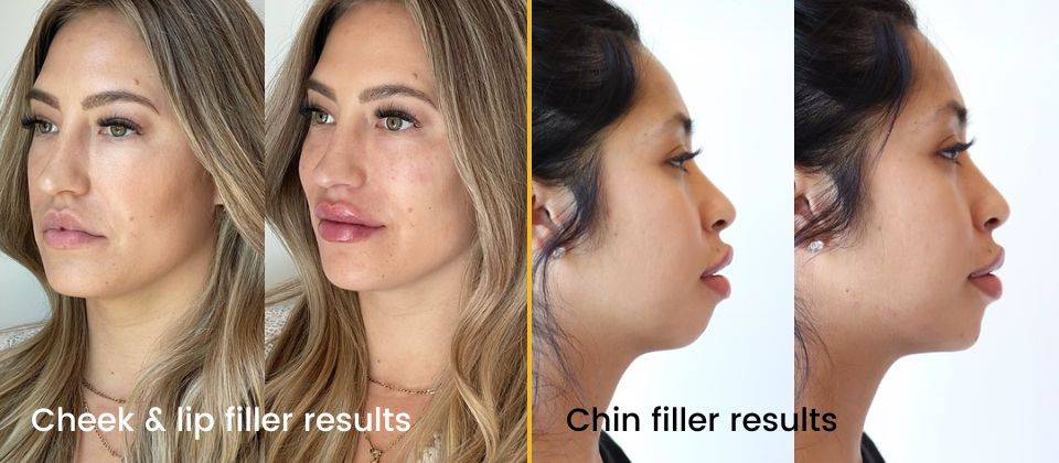 botox, juvederm before and after images