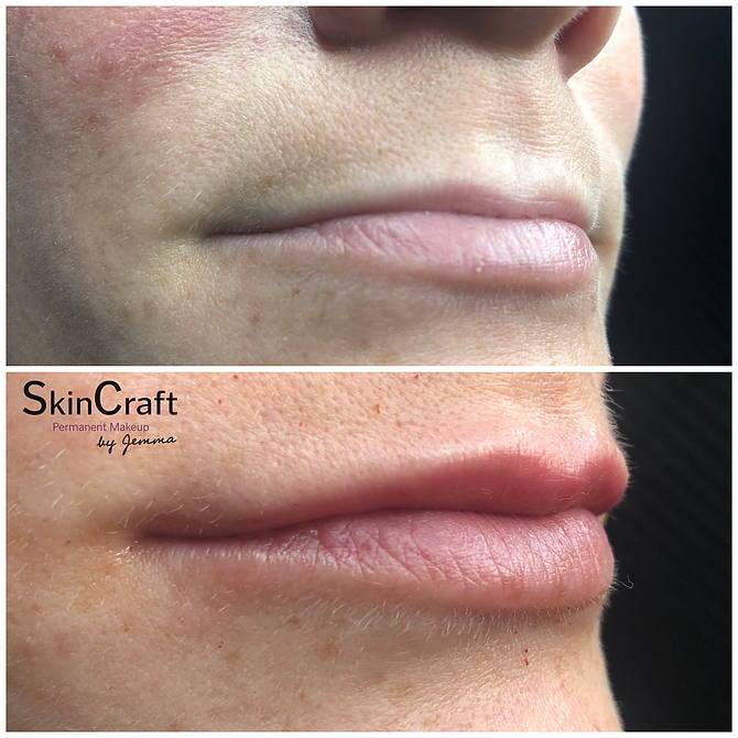 DERMAL FILLERS | Skincraft