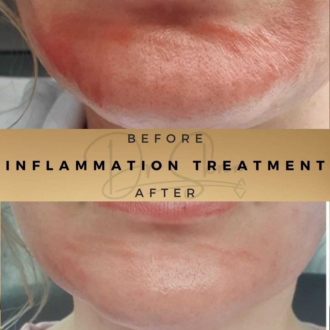 Ezcema & Inflammation Treatment Wilmslow Before & After Dr Sknn