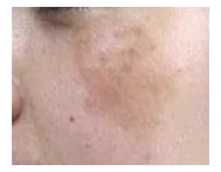 Pregnancy Spots