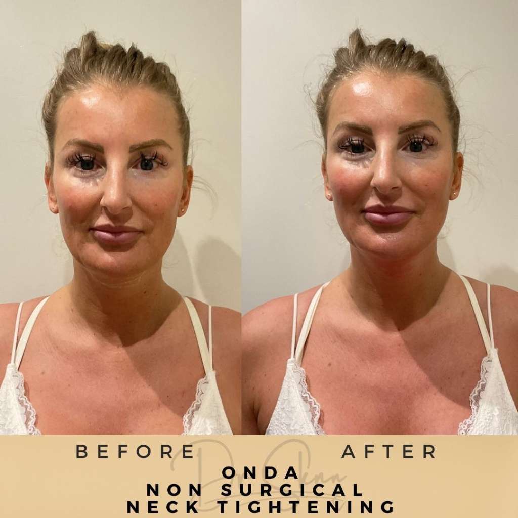 Non Surgical Fat Reduction Wilmslow Before & After Dr Sknn ONDA