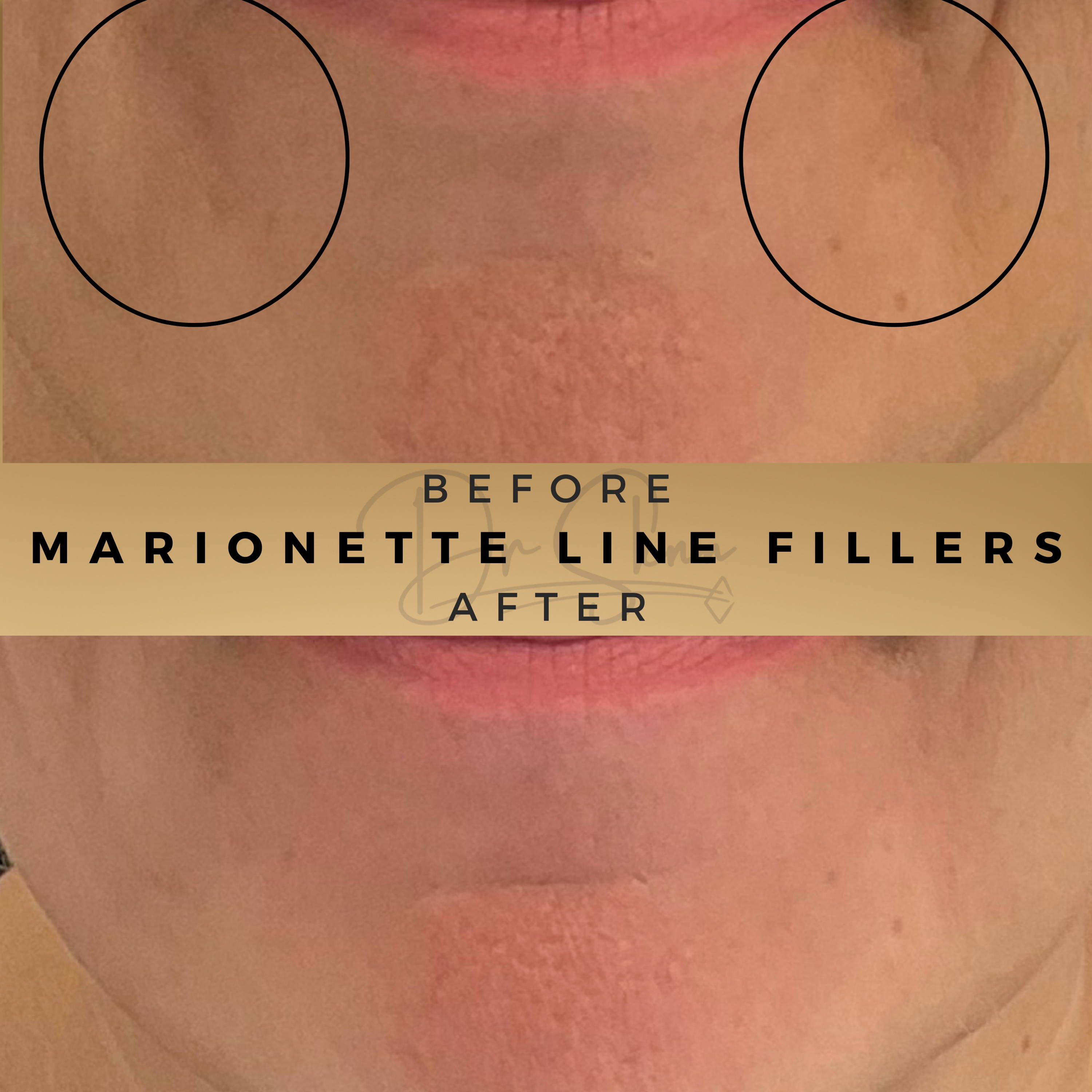 Marionette Line Fillers Wilmslow Before & After Dr Sknn