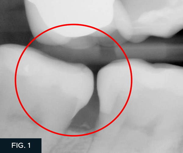 A preoperative radiograph of the patient tooth shows an open contact but the crack being treated is not visible in the radiograph