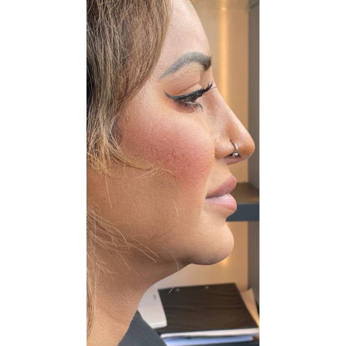 Dr Sknn NECK SKIN TIGHTENING BEFORE