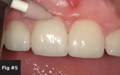 After a 30 second cure with the VALO curing light (Ultradent™) the restoration was polished.