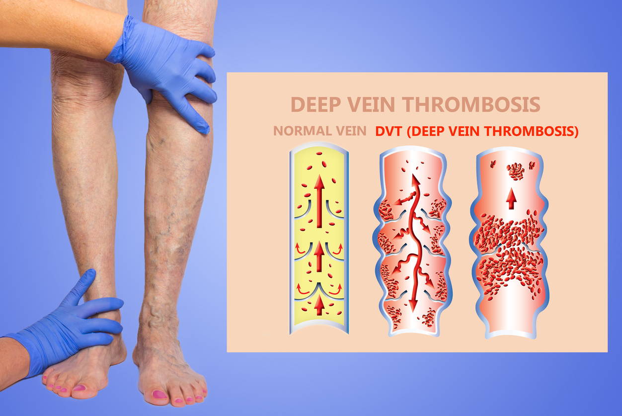 blood clot deep vein thrombosis