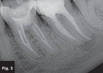 an x-ray view of a sealed root canal
