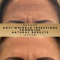 Anti-Wrinkle Injections Wilmslow Before & After Dr Sknn