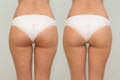 before and after photos of the back view of a woman's thighs, showing the reduction of cellulite over time with the use of collagen