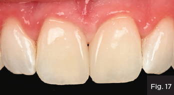 The final restorations mimic the existing translucency of the proximal surfaces of #11 and #21