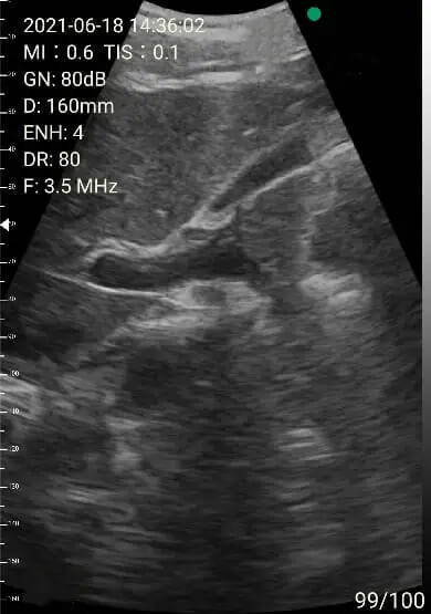 EagleView portable ultrasound image-common bile duct