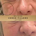 Cheek Fillers Wilmslow