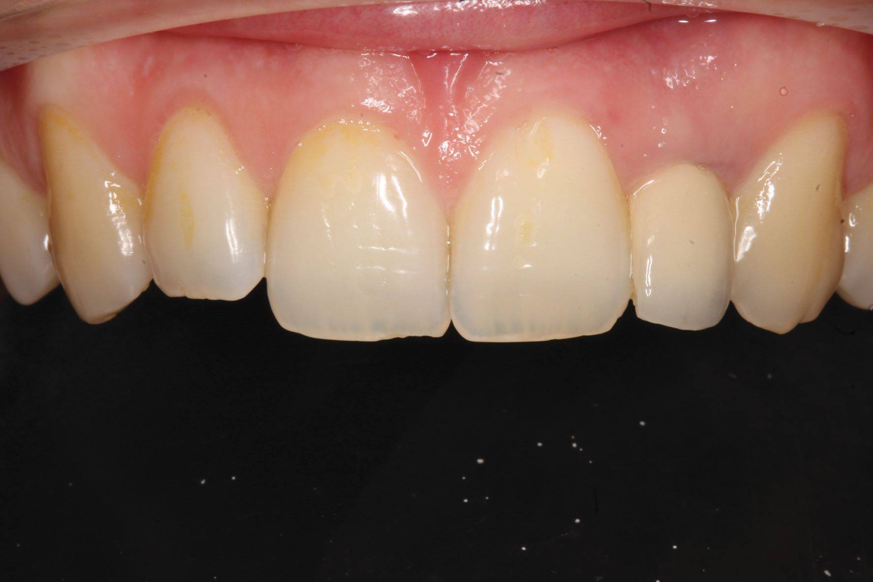 Upper teeth pre-operative frontal view