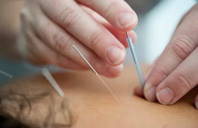 Acupuncture needles inserted into skin during treatment, with hands guiding thin needles.