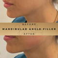 Mandibular Angle Fillers Wilmslow Dr Sknn Before & After Picture