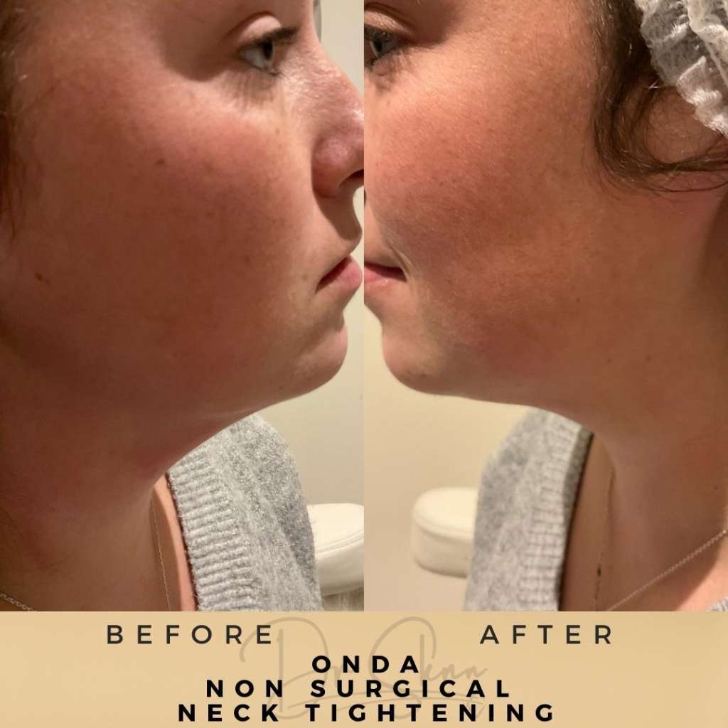 Skin Tightening Wilmslow Before & After Pictures Dr Sknn - Onda treatment