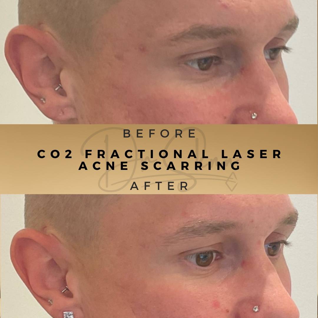 Acne Scarring Treatment Wilmslow Before & After Dr Sknn