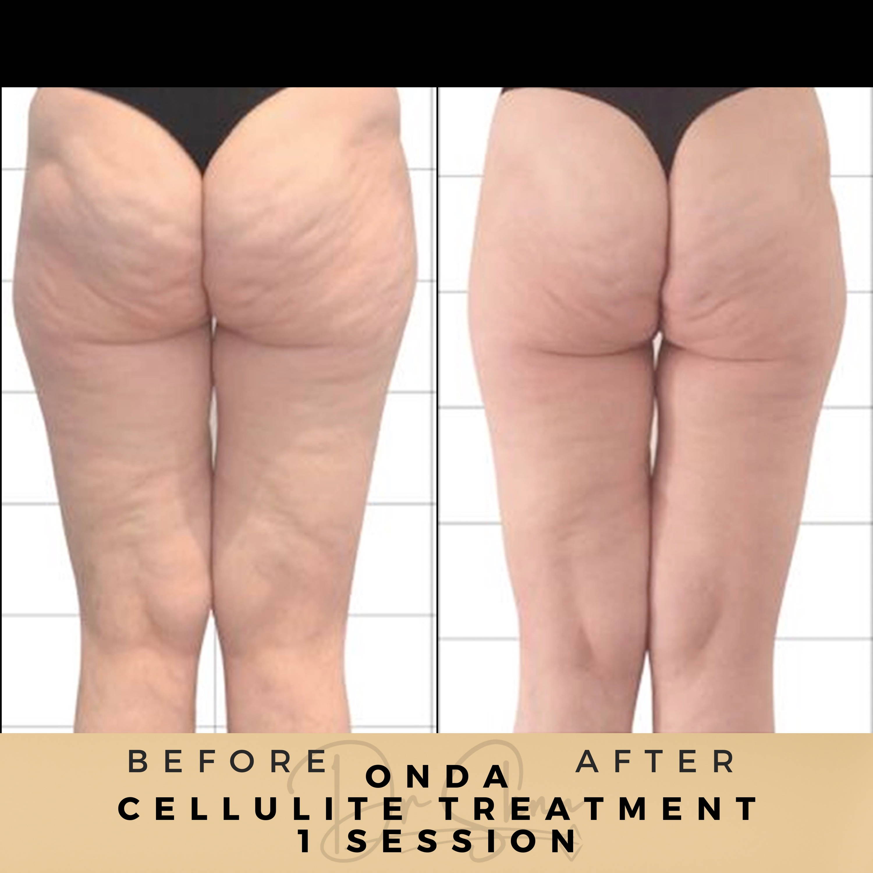 Cellulite Removal - Non-surgical - Dr Sknn before and after