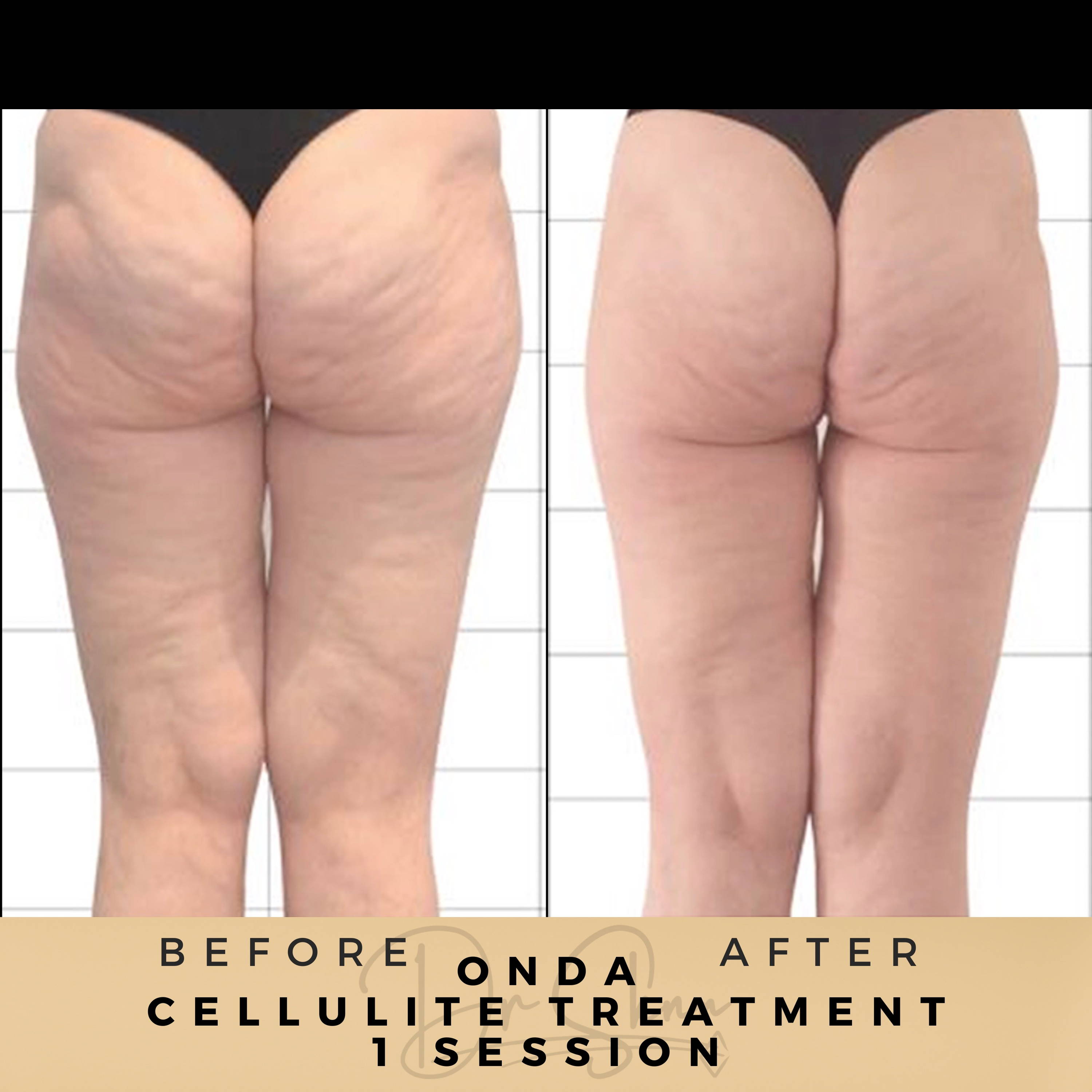 Cellulite Removal Wilmslow Before & After Dr Sknn