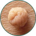 skin tags