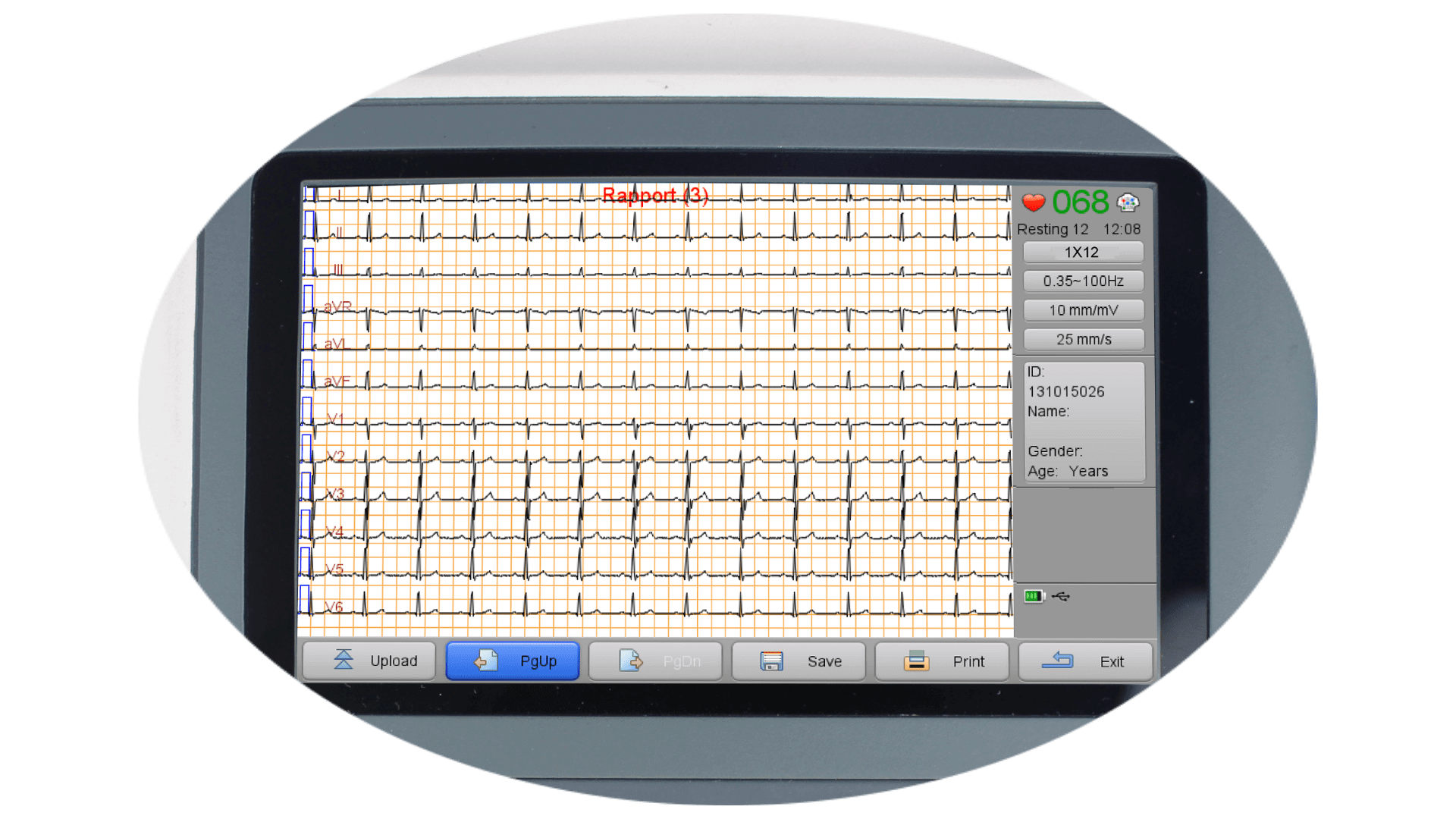 ECG waveforms of 12 leads shown on the Biocare iE300 ECG machine screen