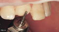 Skinny bur touching anterior tooth