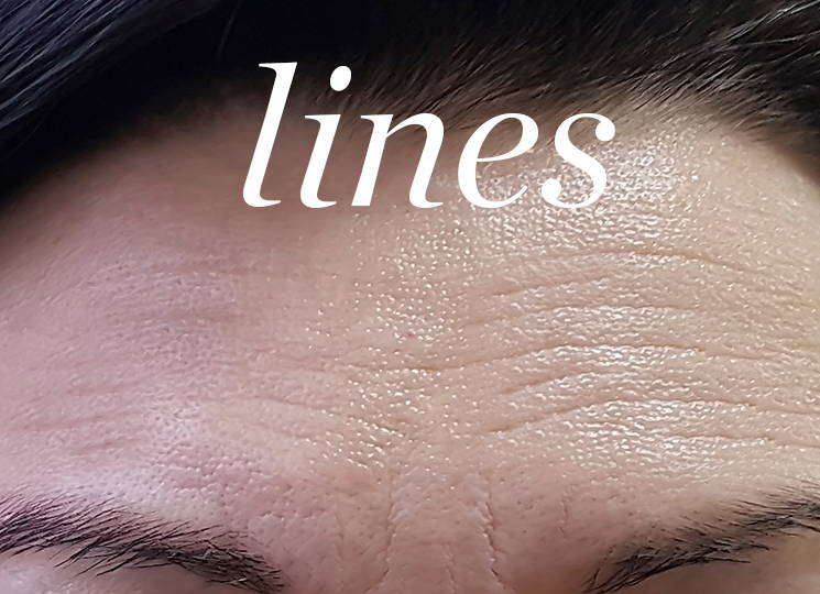 Woman's Forehead Showing Lines - Link to Lines Section of Same Page
