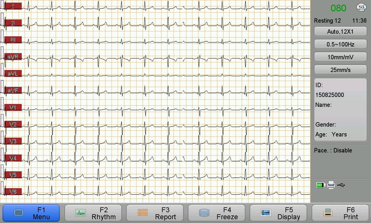 Formas de onda de ECG de 12 canales mostradas en la pantalla