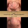 IPL Thread Vein Treatment Wilmslow Dr Sknn Before & After Picture