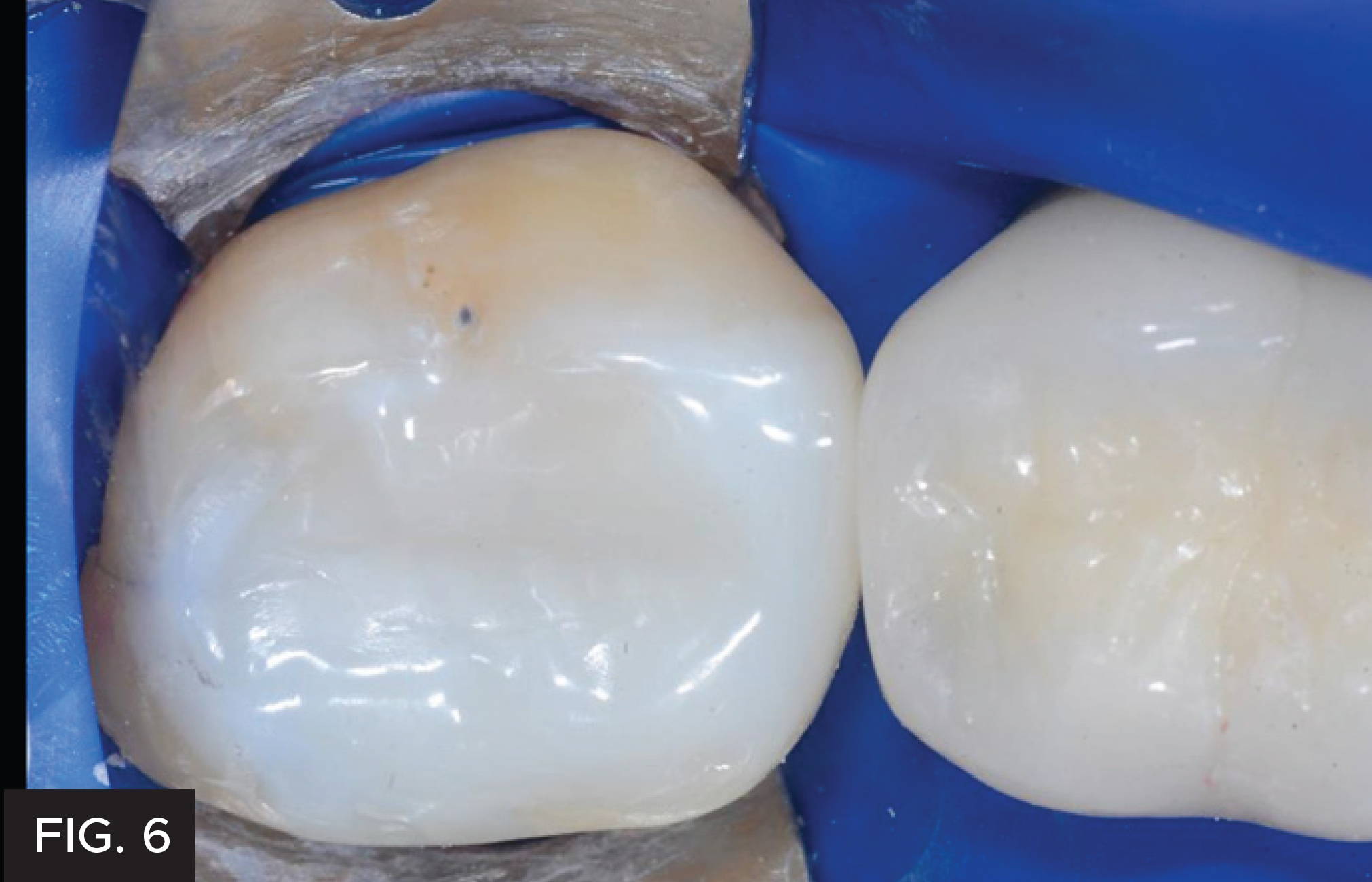 Class II Restoration: Bioclear. Fig. 6