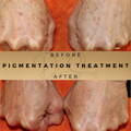 REMOVE AGE SPOTS Before & After Picture