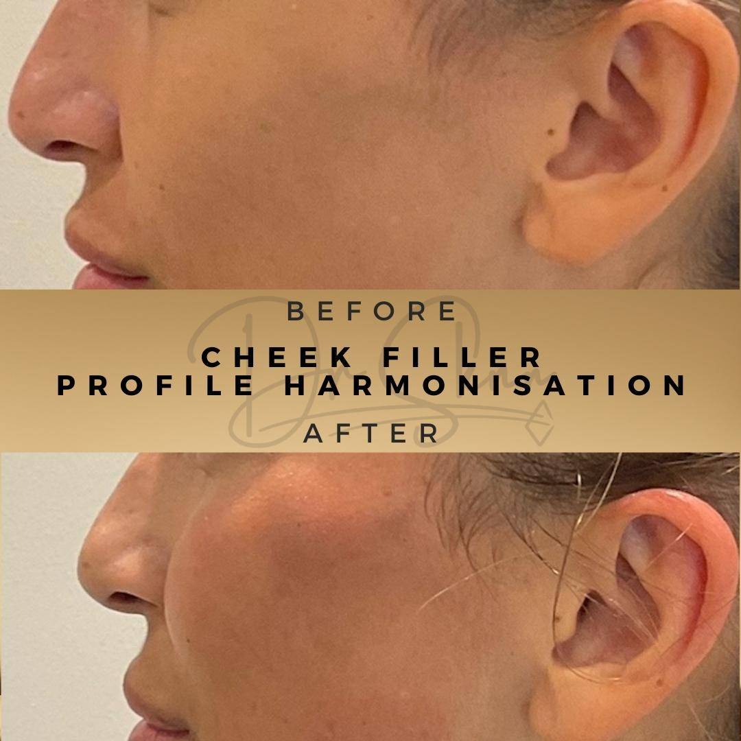 Cheek Fillers - Dr Sknn before and after