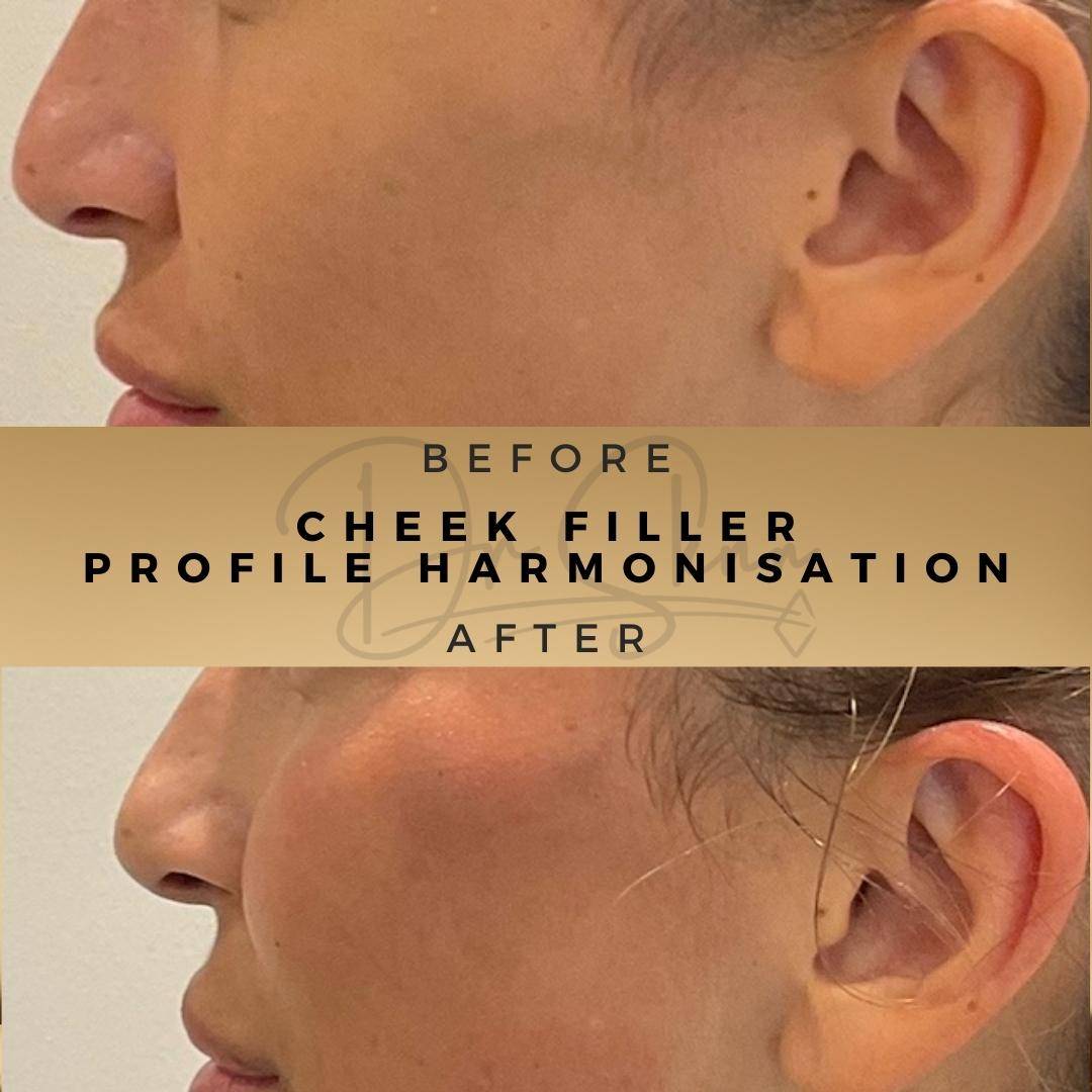 Cheek Fillers Wilmslow Before & After Dr Sknn
