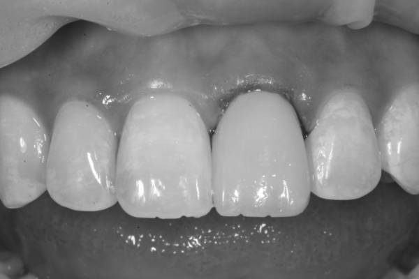 Black and white image of teeth beside an image with silver powdered teeth