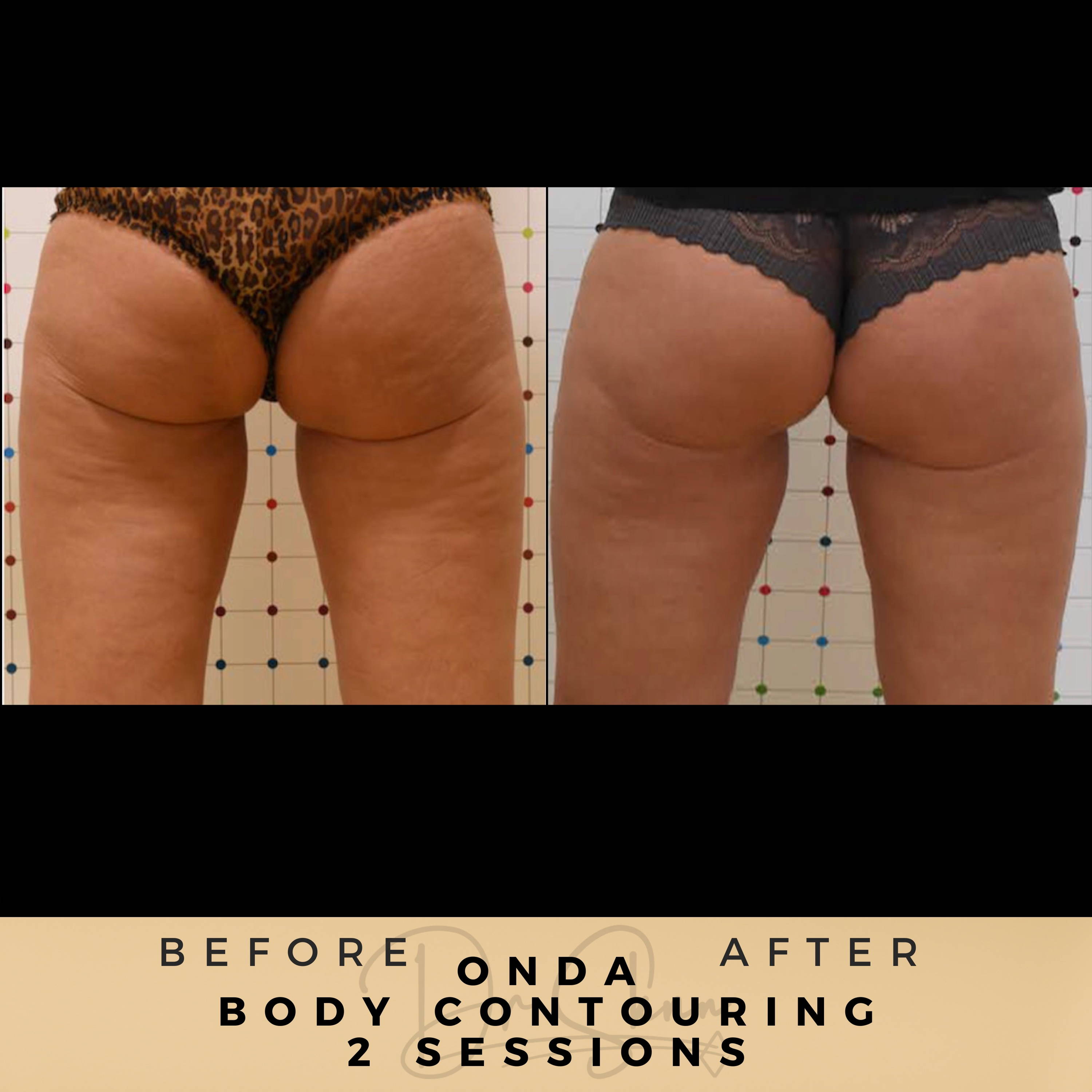 Body Contouring - Non-surgical - Dr Sknn before and after
