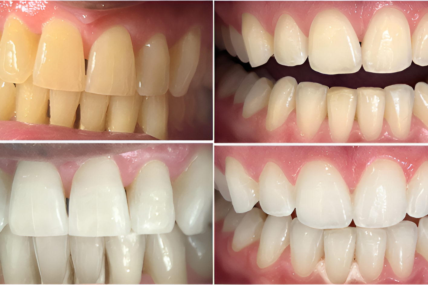 Customised Cosmetic Teeth Whitening $10 Voucher - Image 5