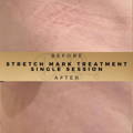 Stretch Marks Treatment Co2 Fractional Laser Wilmslow Dr Sknn Before & After Picture